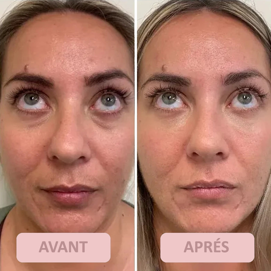 LE TRAITEMENT ULTIME POUR LE CONTOUR DES YEUX