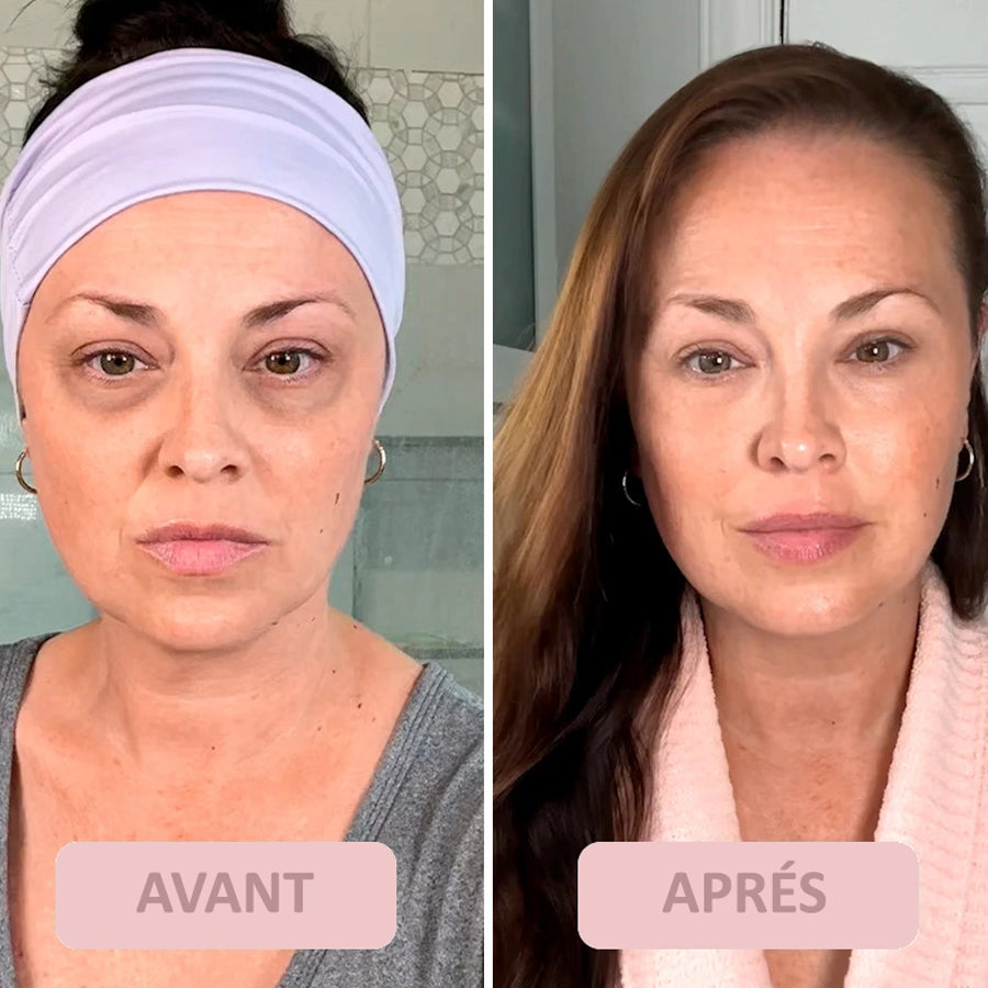 LE TRAITEMENT ULTIME POUR LE CONTOUR DES YEUX