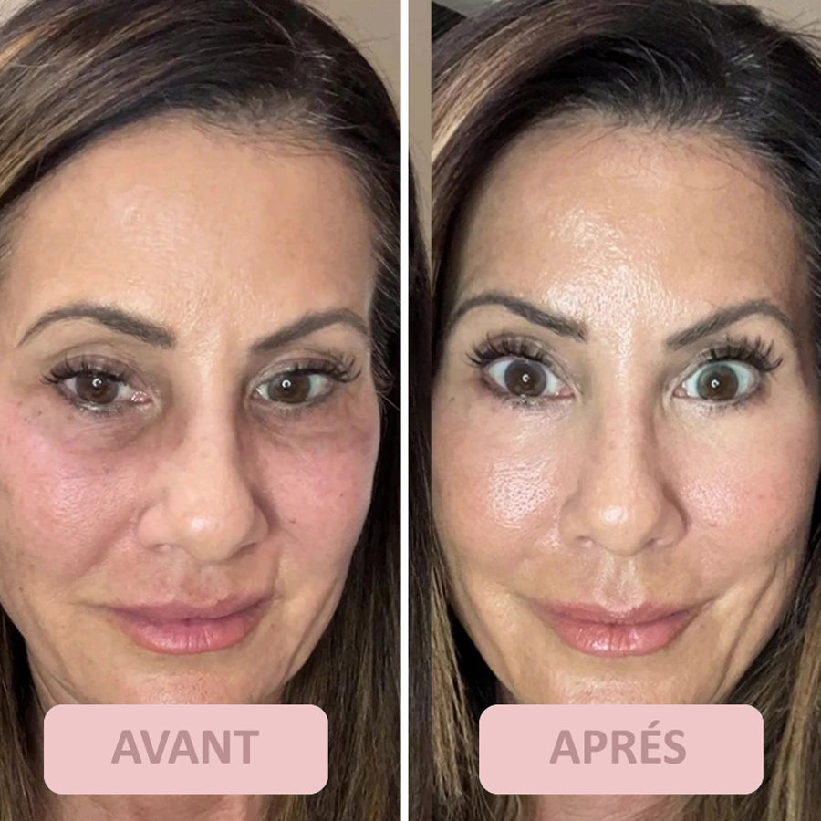 LE TRAITEMENT ULTIME POUR LE CONTOUR DES YEUX