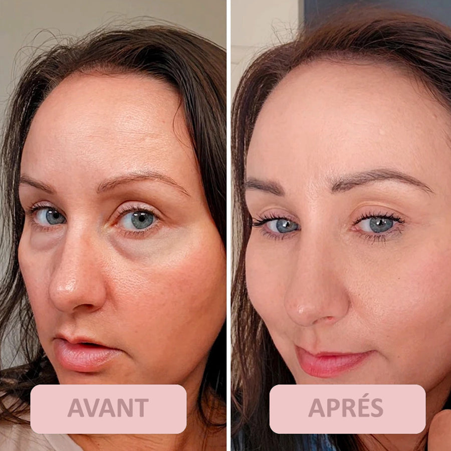 LE TRAITEMENT ULTIME POUR LE CONTOUR DES YEUX