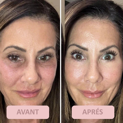 LE TRAITEMENT ULTIME POUR LE CONTOUR DES YEUX